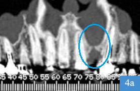 coupe panoramique de dentascanner, dent 22 absente