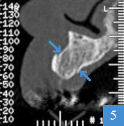 4 mois après la greffe osseuse, largeur de 9,5 mm