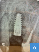 implant dentaire en place