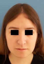 femme de profil en post-opératoire