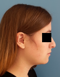 femme de profil en post-opératoire