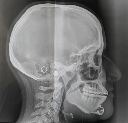 téléradiographie crâniofaciale de profil en post-opératoire