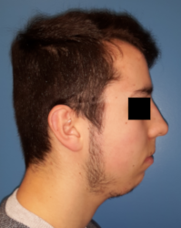 homme de profil avec rétrogénie