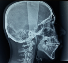 téléradiographie crâniofaciale de profil