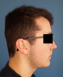 homme de profil en post-opératoire