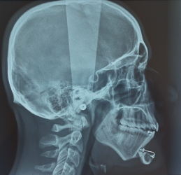 téléradiographie crâniofaciale de profil en post-opératoire