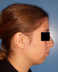 femme de profil avec rétrogénie