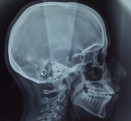 téléradiographie crâniofaciale de profil