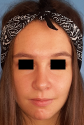 femme de face en post-opératoire