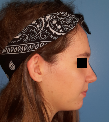 femme de profil en post-opératoire