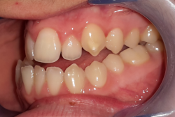 occlusion dentaire anormale