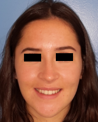 femme de face en post-opératoire