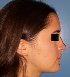 femme de profil en post-opératoire