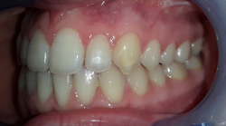 occlusion dentaire normale