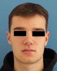 homme de face en post-opératoire