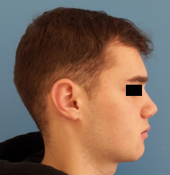 homme de profil en post-opératoire