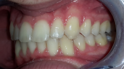 occlusion dentaire normale