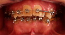 occlusion dentaire anormale