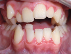 occlusion dentaire anormale