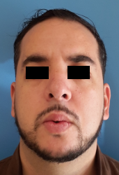 homme de face en post-opératoire