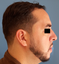 homme de profil en post-opératoire