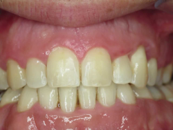 occlusion dentaire normale