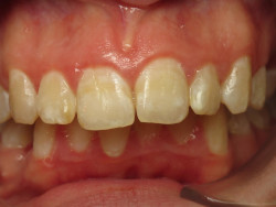 occlusion dentaire anormale