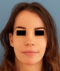 femme de face en post-opératoire