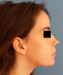 femme de profil en post-opératoire