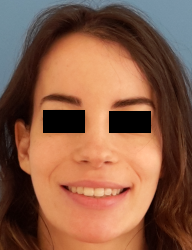 sourire en post-opératoire