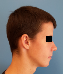 homme de profil en post-opératoire