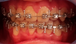 occlusion dentaire normale