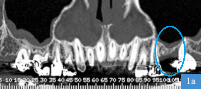 coupe panoramique de dentascanner, dent 26 absente