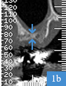 coupe coronale de dentascanner, hauteur osseuse de 3 mm seulement