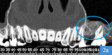 coupe panoramique de dentascanner, 4 mois après la greffe osseuse