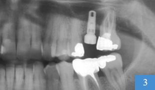 implant dentaire en place